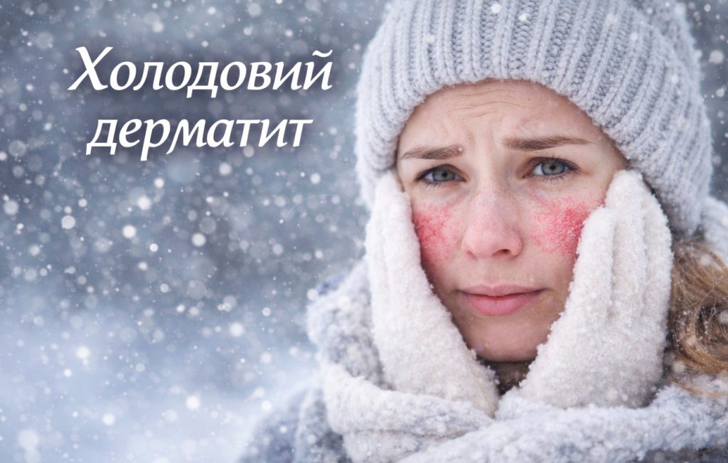 Холодовий дерматит